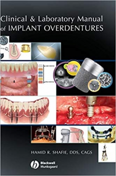 خرید اینترنتی کتاب Clinical and Laboratory Manual of Implant Overdentures 1st Edition