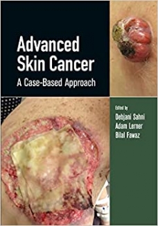 کتاب Advanced Skin Cancer: A Case-Based Approach